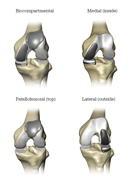 Mako SmartRobotics™ for Total Knee Replacement