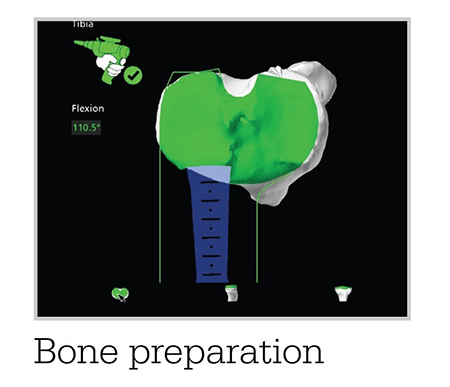 Mako SmartRobotics™ for Total Knee Replacement