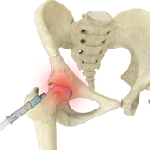 Hip Injections