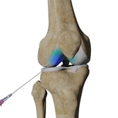 Intra Articular Knee Injection